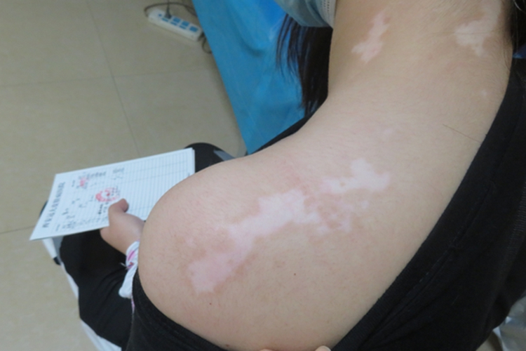 日光性白斑肩部白斑图 日光性白斑肩部白斑图