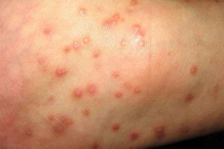 疥疮结节图