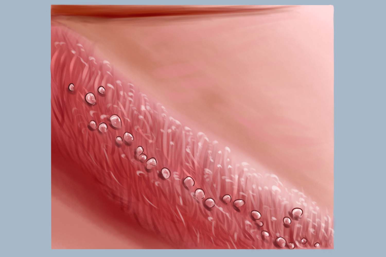 珍珠状阴茎丘疹图 珍珠状阴茎丘疹图