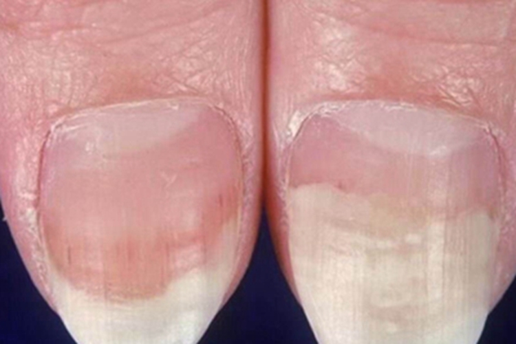 甲分离指甲剥离程度较深图