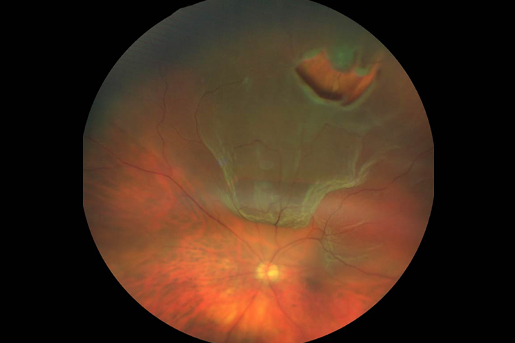 小孩视网膜裂孔与脱离图