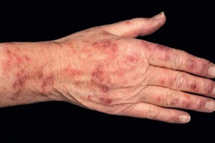 亚急性皮肤型红斑狼疮症状图