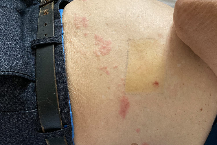 腹部轻度带状疱疹图