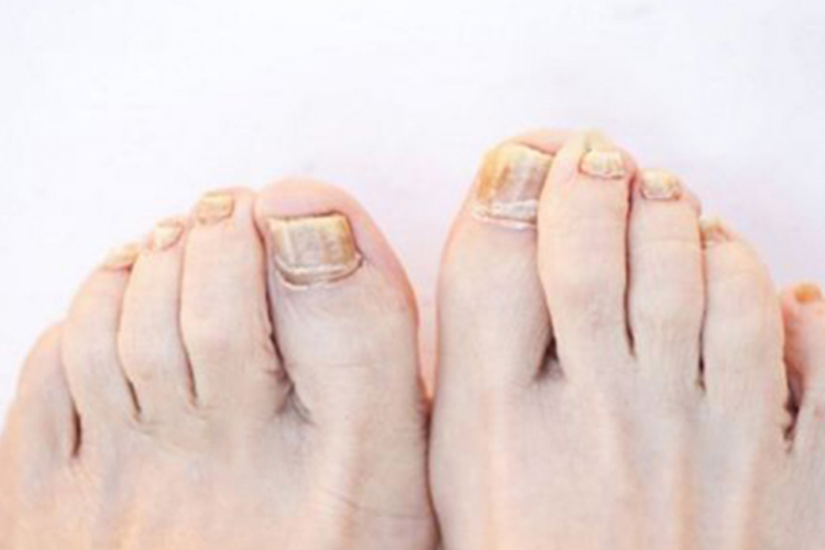 趾甲变形脆裂图 趾甲变形脆裂图