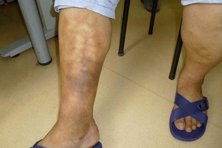 男人下肢静脉血栓脚肿图 男人下肢静脉血栓脚肿图