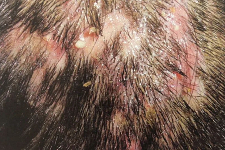 脱发性毛囊炎红肿图