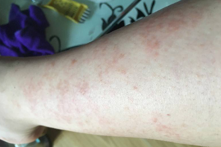 激光脱毛后皮肤灼伤图 激光脱毛后皮肤灼伤图