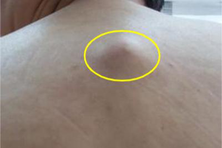 皮下脂肪瘤背部症状图