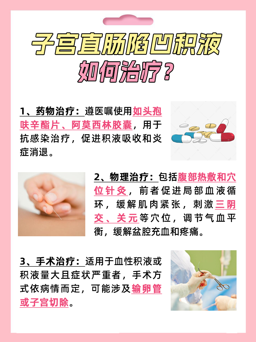 子宫直肠陷凹积液是怎么回事？你知道吗？