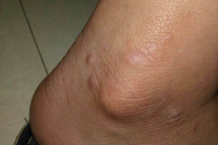 平滑肌瘤脚踝圆疙瘩图