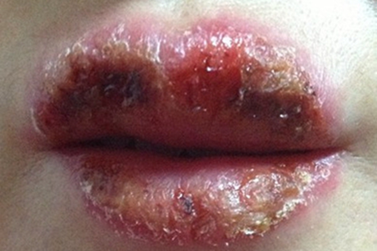 三期口腔梅毒症状图