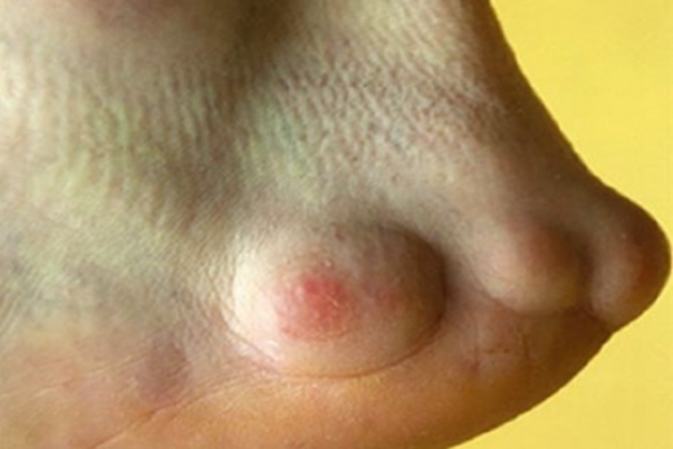 结节病脚后跟症状图 结节病脚后跟症状图