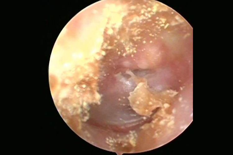 外耳道真菌病图 外耳道真菌病图