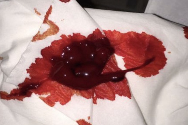 胃溃疡血便图 胃溃疡血便图