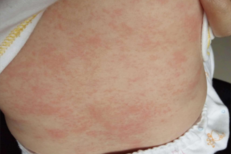 红痱背上全是小红点图 红痱背上全是小红点图