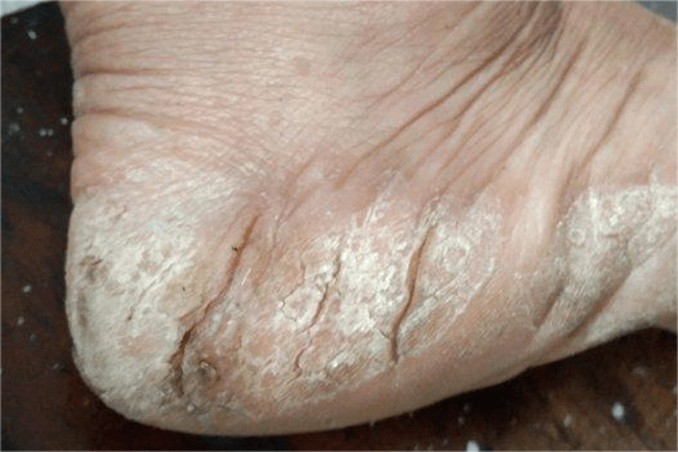 鳞屑角化型足癣脚后跟脱屑图