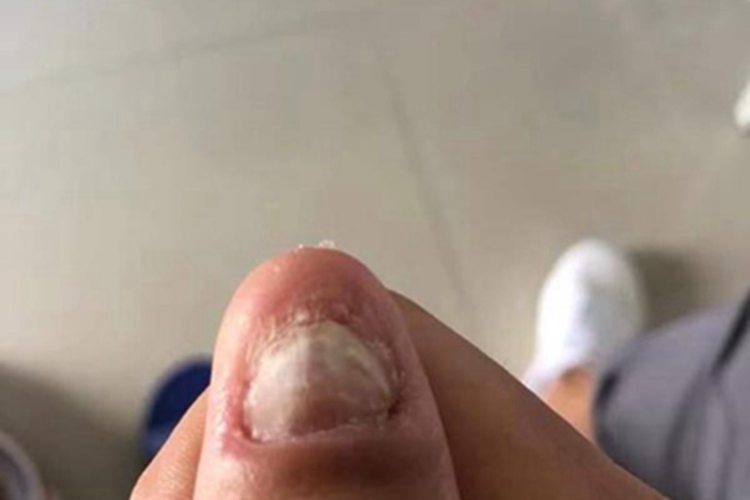 脱甲病甲萎缩图