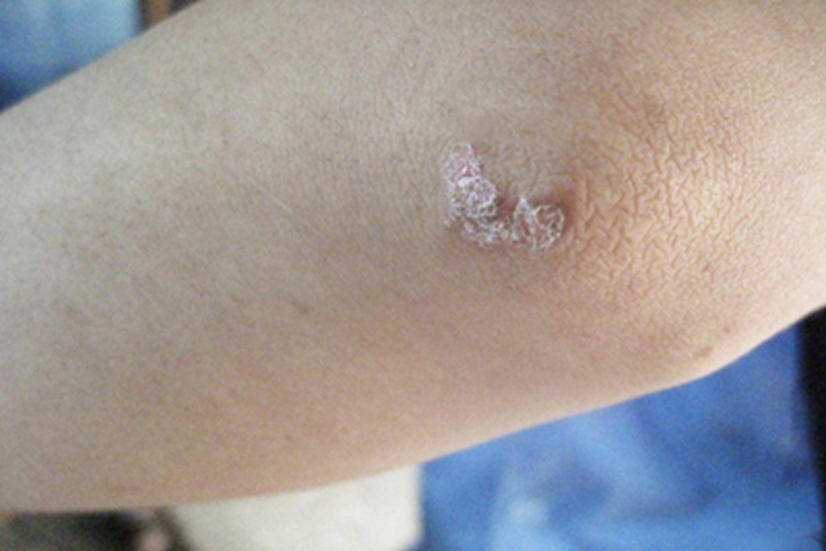 毛发红糠疹胳膊肘粗糙起皮图