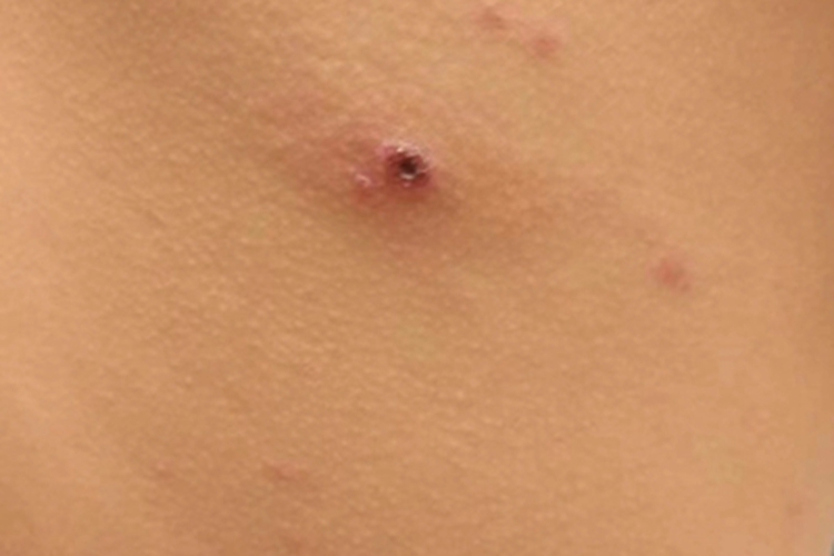 毛囊炎背部结痂图