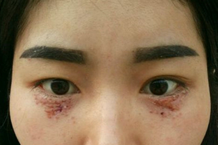 汗腺瘤眼睑丘疹激光后结痂图 汗腺瘤眼睑丘疹激光后结痂图