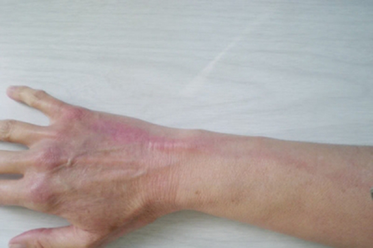 血栓性浅静脉炎手背红肿图