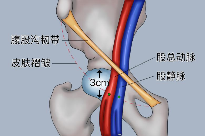股静脉与股动脉位置关系图