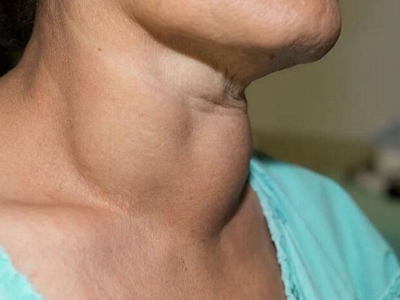 结节性甲状腺肿颈部右侧和正面有肿块图.jpg
