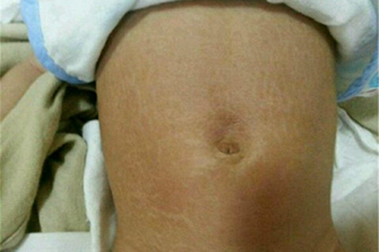 鱼鳞病腹部裂纹图