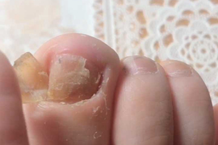 脱甲病脚趾甲甲掉下来图