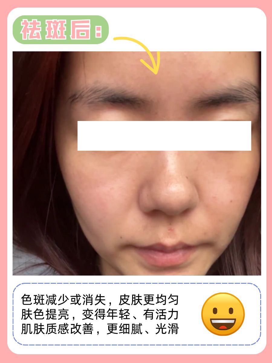 祛斑的前后效果图对比！附面部护理大全