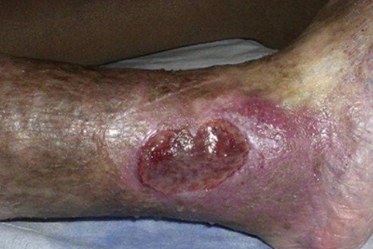 静脉曲张性溃疡皮肤溃疡图