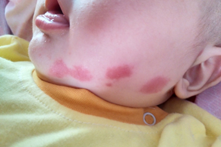 体虱病面部症状图