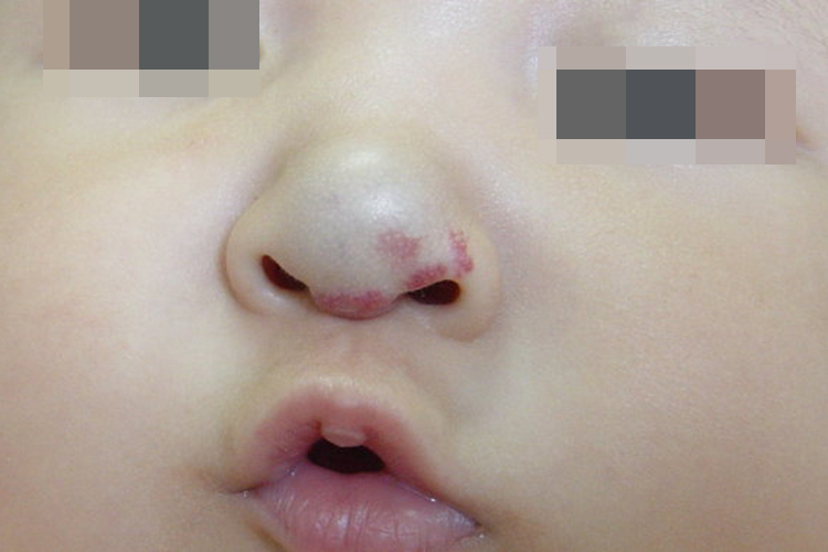 海绵状血管瘤图