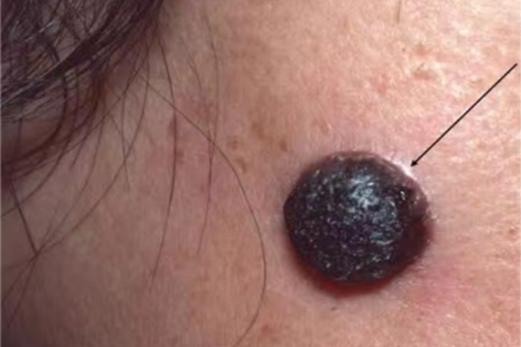 疣状脂溢性角化症大疙瘩图