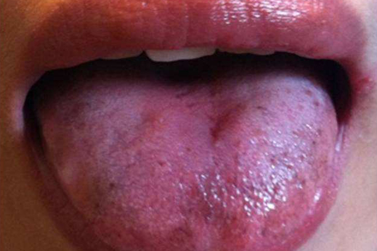 舌质紫暗有瘀斑图