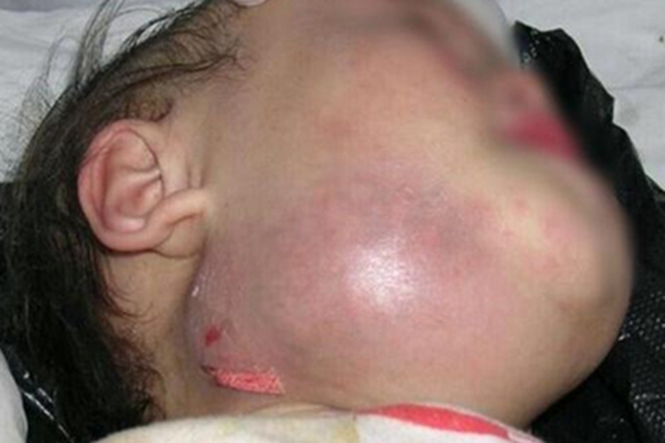 婴幼儿化脓性淋巴结炎颈部充血图