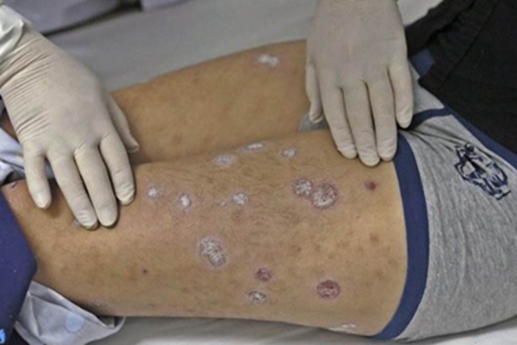 结节性梅毒疹大腿症状图 结节性梅毒疹大腿症状图