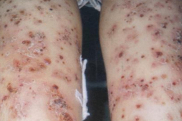 暴发性痤疮小腿丘疹图 暴发性痤疮小腿丘疹图