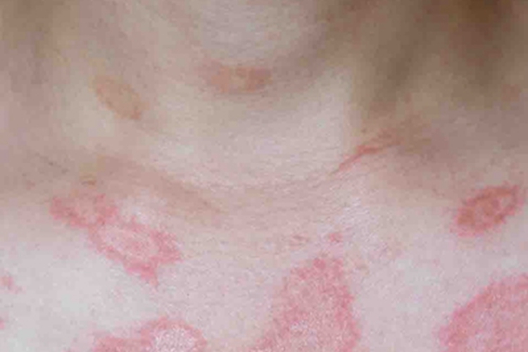 湿疹样紫癜胸部红斑图