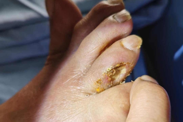 皮肤白喉脚趾缝糜烂图 皮肤白喉脚趾缝糜烂图