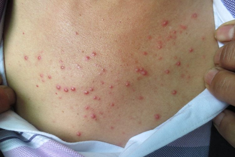 胸口马拉色菌毛囊炎图