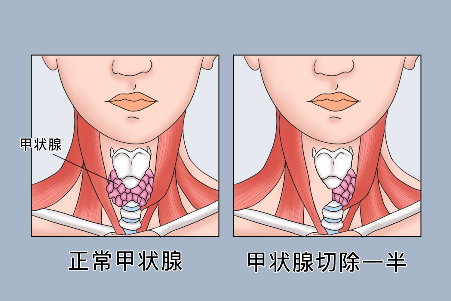 甲状腺切除一半的形状图 甲状腺切除一半的形状图