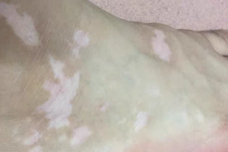 非节段型白癜风脚背症状图 非节段型白癜风脚背症状图