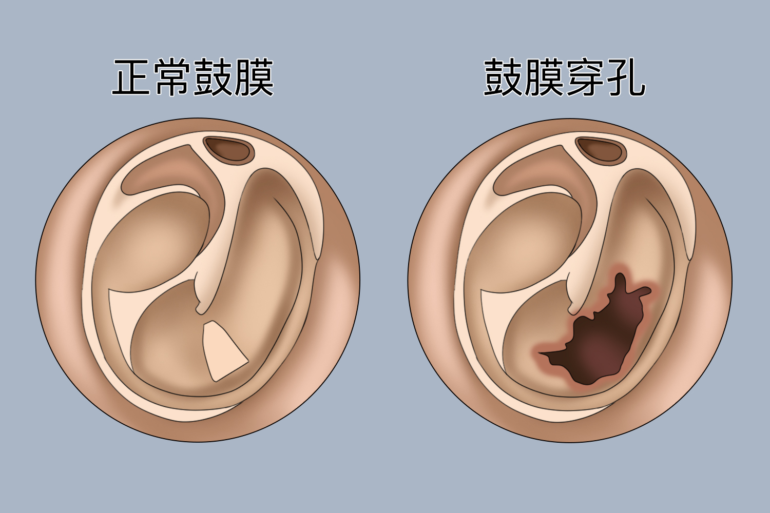 外伤致耳膜穿孔图
