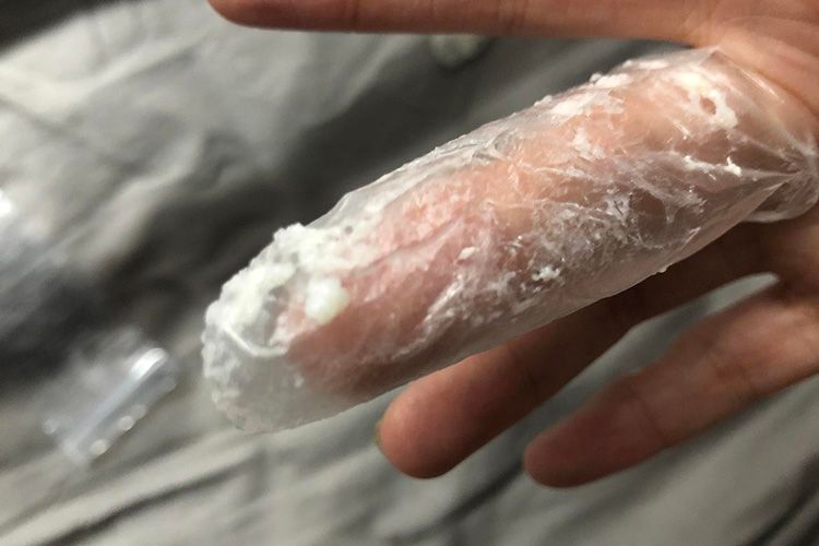 白色豆腐渣样白带图