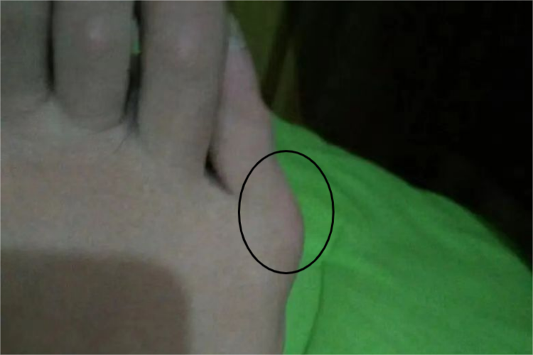 小脚趾腱鞘囊肿图 小脚趾腱鞘囊肿图