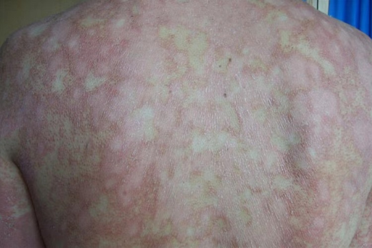 毛发红糠疹性红皮病背部丘疹图
