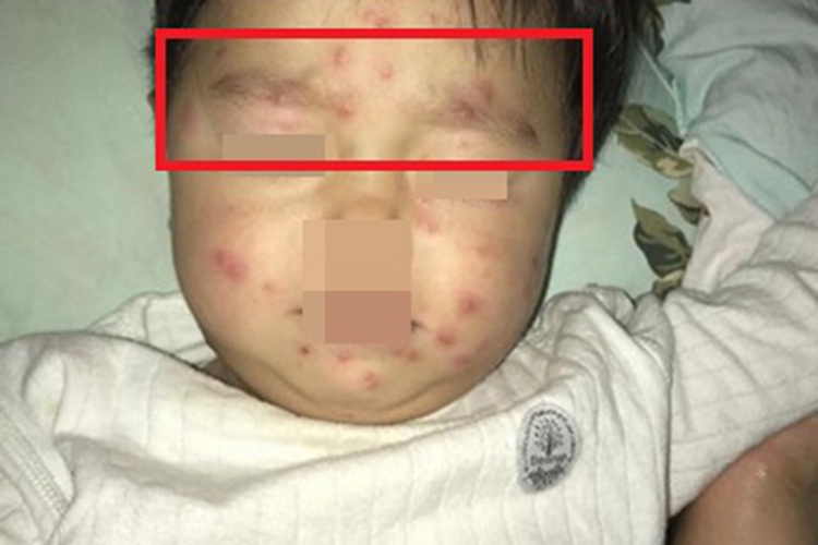 水痘眉毛红斑图