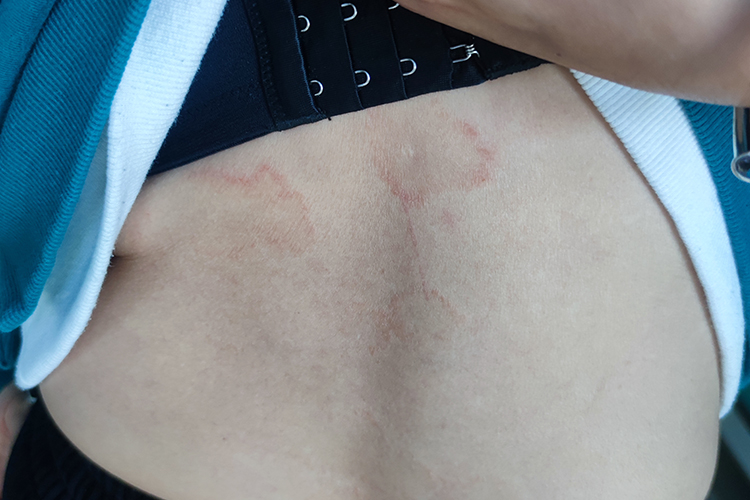 体癣红色斑片图 体癣红色斑片图