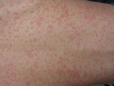典型麻疹出疹期背上长大小不等的红疹图.jpg